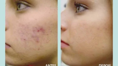 Saiba mais sobre a Luz Intensa Pulsada – LIP