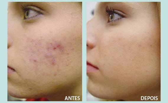 Rosto Luz Pulsada Intensa Manchas Rejuvenescimento E Eliminação De