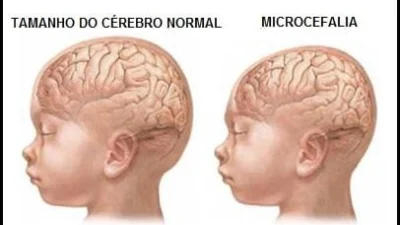 Orientações às gestantes sobre  os casos de microcefalia