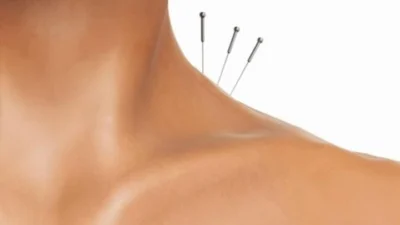 Acupuntura trata TPM, cólicas menstruais e previne doenças