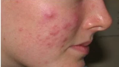 Saiba mais sobre a acne e como tratar corretamente o problema