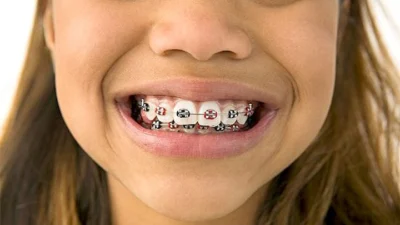 Saiba qual a idade certa para corrigir os dentes de seu filho
