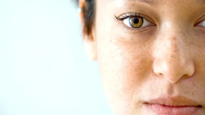 Conheça os diferentes tratamentos para manchas