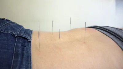 Acupuntura pode reduzir medidas e diminuir estrias e celulites