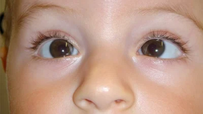 Dificuldade de visão em um dos olhos pode indicar estrabismo