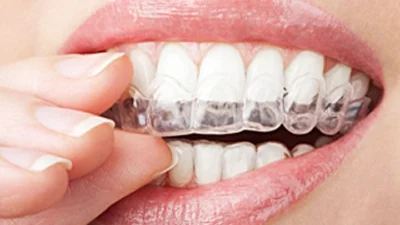 Tire suas dúvidas sobre o clareamento dental