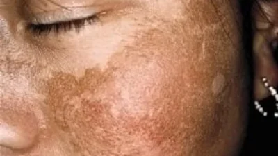 Grávidas têm mais predisposição para manchas no rosto