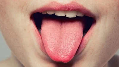 Movimentação inadequada da língua causa problemas na fala e alimentação