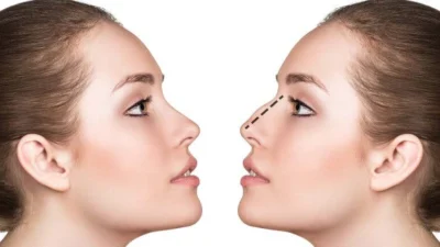 Rinoplastia é a sétima cirurgia plástica mais realizada no País, segundo pesquisa da Isaps