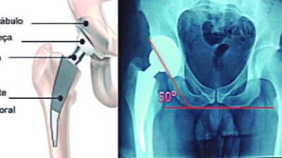 Artrose e osteoporose são recorrentes acima dos 65 anos
