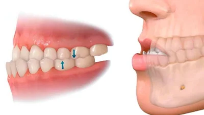 Encaixe irregular dos dentes causa interferência na formação dos maxilares
