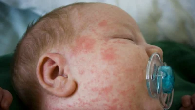 No calor, manchas vermelhas e coceiras podem indicar alergias