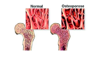 Osteoporose afeta mais mulheres do que homens, diz ortopedista