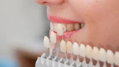 Lente de contato dental: conheça a técnica e em quais casos ela não é indicada