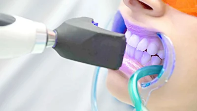 Clareamento dental com LED é a opção mais segura e indolor, afirma dentista