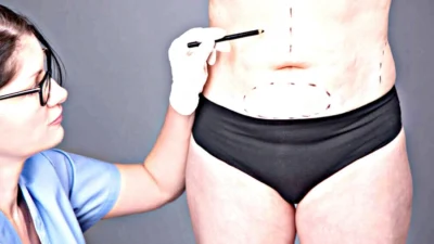 Abdominoplastia em âncora reduz excesso de pele após bariátrica