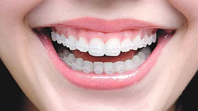 Busca por tratamentos odontológicos com aparelhos cresce para adultos