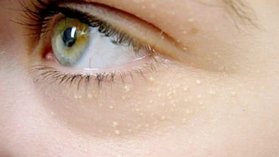 Xantelasma é consequência do alto nível de gordura no sangue