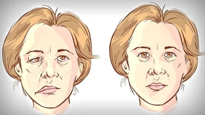 Paralisia Facial pode ser consequência de excesso de estresse, fadiga, entre outros