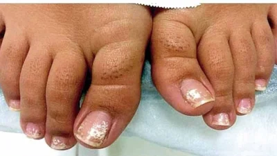 Período de calor aumenta  incidência de micoses nas unhas