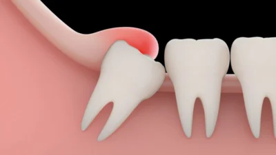 Dentes do ‘Siso’: é importante extraí-los?