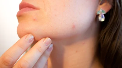 O que a acne pode revelar sobre sua saúde