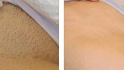 Saiba mais sobre o novo método para se livrar dos pelos indesejados