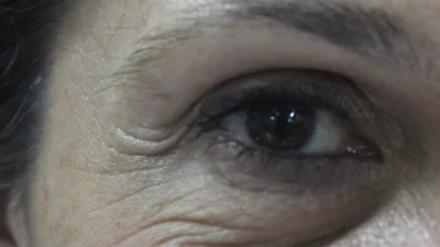 Blefaroplastia: a cirurgia para  eliminar sinais do envelhecimento