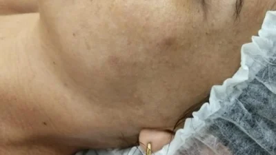 Conheça os tipos de manchas na pele