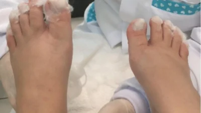 Carnaval: cuidado com os pés deve ser antes e depois do período de festas