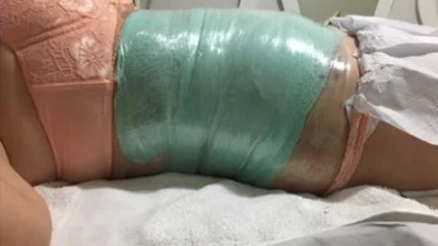 Lipoescultura gessada permite um resultado rápido na eliminação de gordura localizada