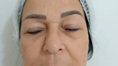 Conheça um pouco sobre o Eletrocautério