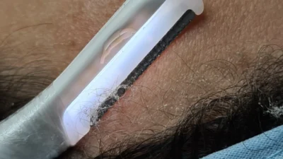 Dermaplaning: a queridinha do momento