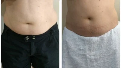 Conheça mais sobre a criolipólise