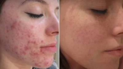 Peeling Químico para tratamento de acne, manchas, rugas e linhas de expressão