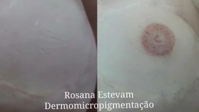 Outubro rosa: dermopigmentação e a autoestima