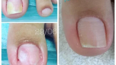 Saiba mais sobre o tratamento de micoses e fungos