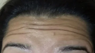 Rugas faciais são todas iguais?
