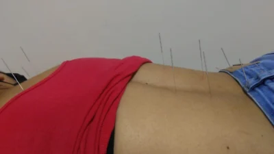 Saiba mais sobre a acupuntura no tratamento da fibromialgia