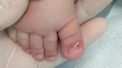 Seu bebê sofre com unhas encravadas?