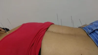 Papel da Acupuntura no tratamento da ansiedade, depressão e síndrome do pânico