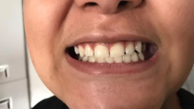 Doença da nova geração: doença não cariosa