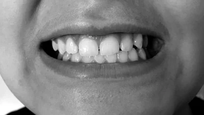 Conheça mais sobre o Bruxismo