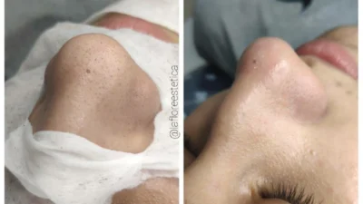 Por que fazer limpeza de pele frequentemente?