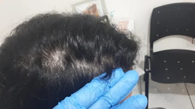 Alopecia: conheça mais sobre os tipos, causas, sintomas e tratamento