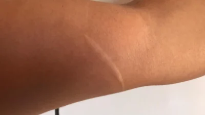 Queloides: o que são e como tratá-las