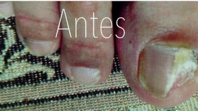 Podologia tem papel importante no tratamento das micoses nas unhas