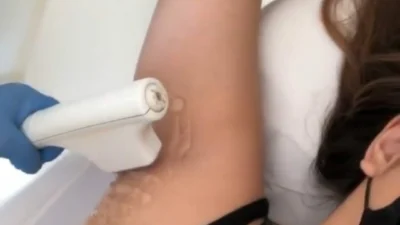 Conheça mais sobre os benefícios da depilação a laser