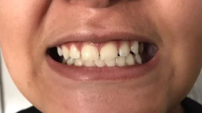 Cuidados básicos ajudam na prevenção da cárie dental