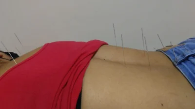 Pós-Covid: Acupuntura no tratamento das sequelas